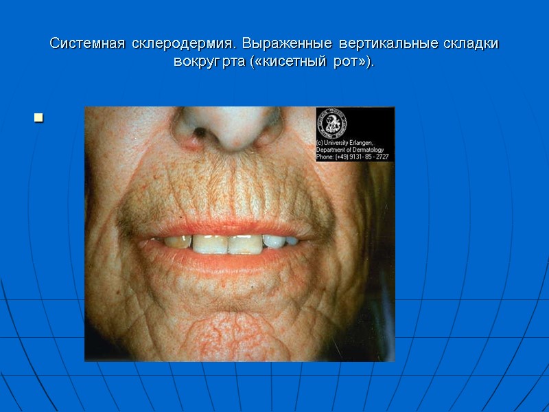Системная склеродермия. Выраженные вертикальные складки вокруг рта («кисетный рот»).